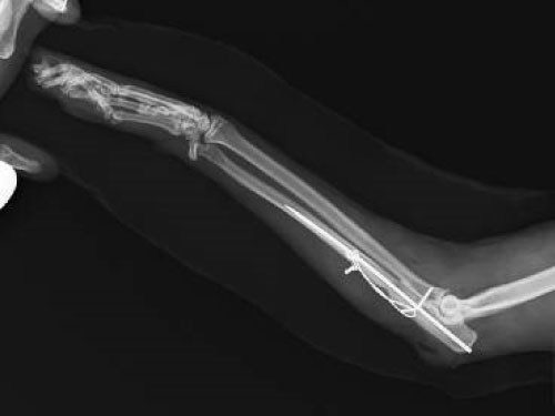 尺骨モンテジア骨折整復 髄内ピン+テンションバンド固定法 1歳 雑種ネコ