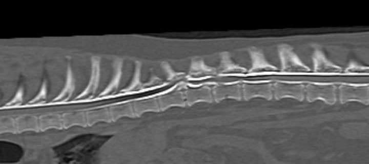 脊髄造影CT検査写真 脊髄神経が椎間板物質により圧迫を受けています。
