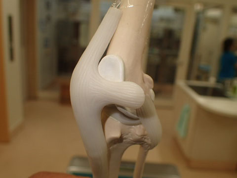 膝蓋骨内方脱臼骨模型