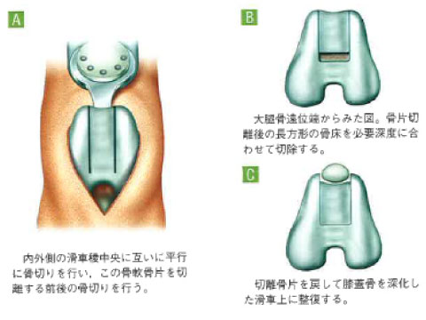 膝関節骨切り術 (ブロックリゼッション法)<br>(株)インターズー SURGEON76 より抜粋